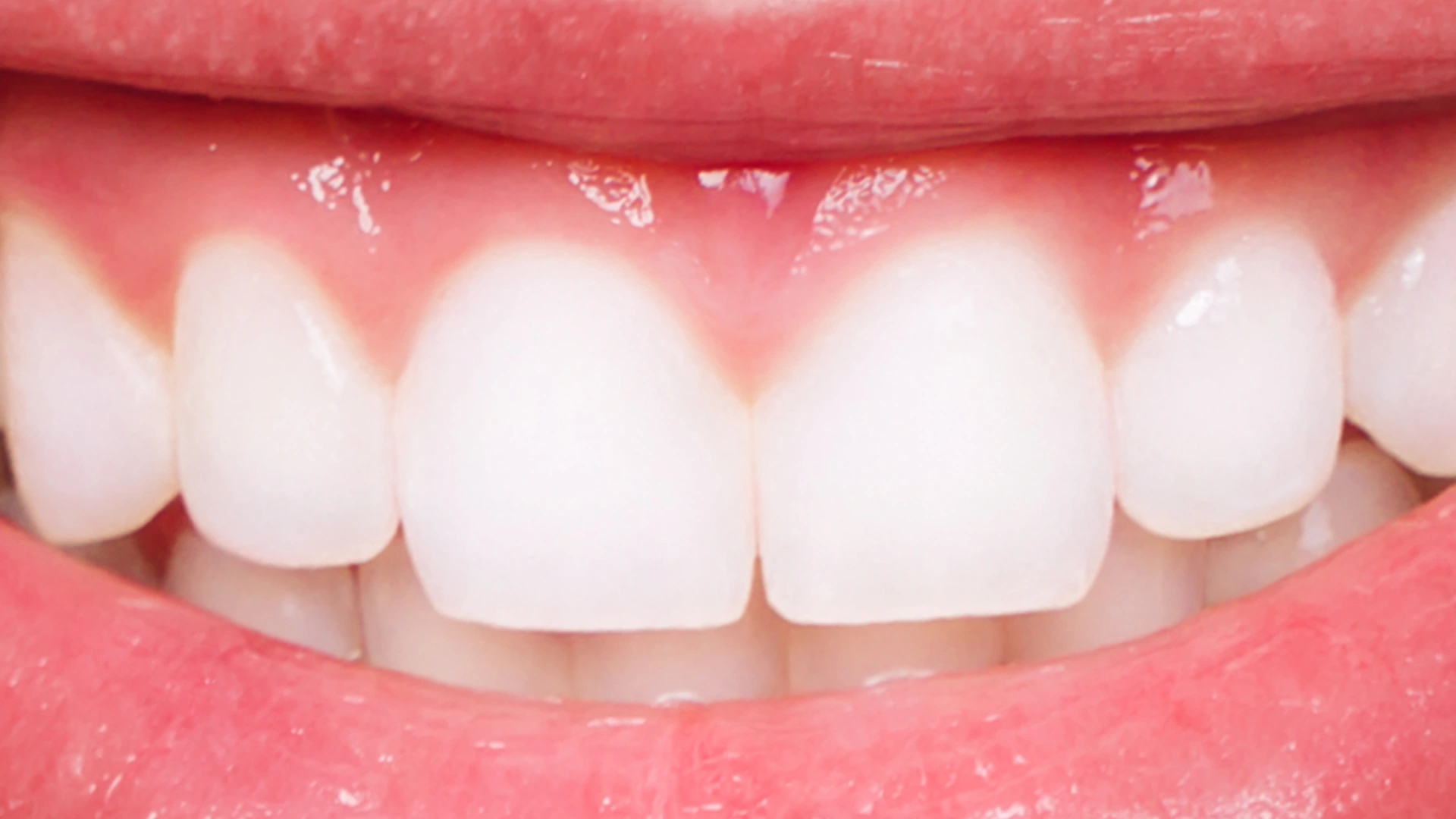 whitening after