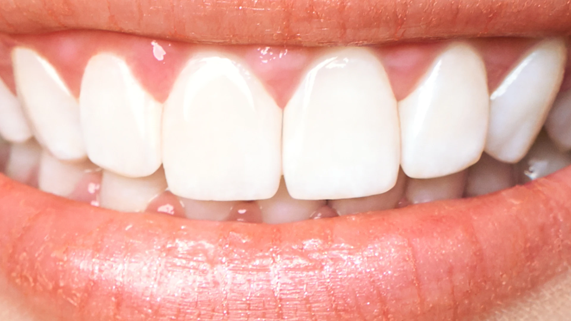 whitening after case3