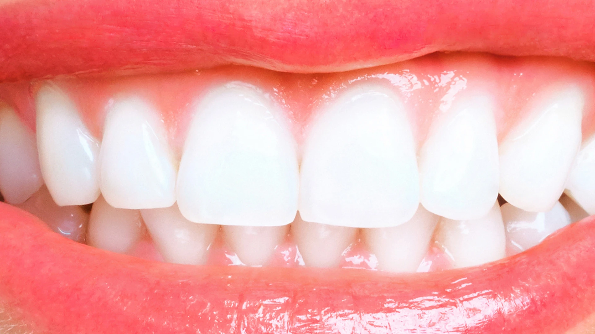 whitening after case2