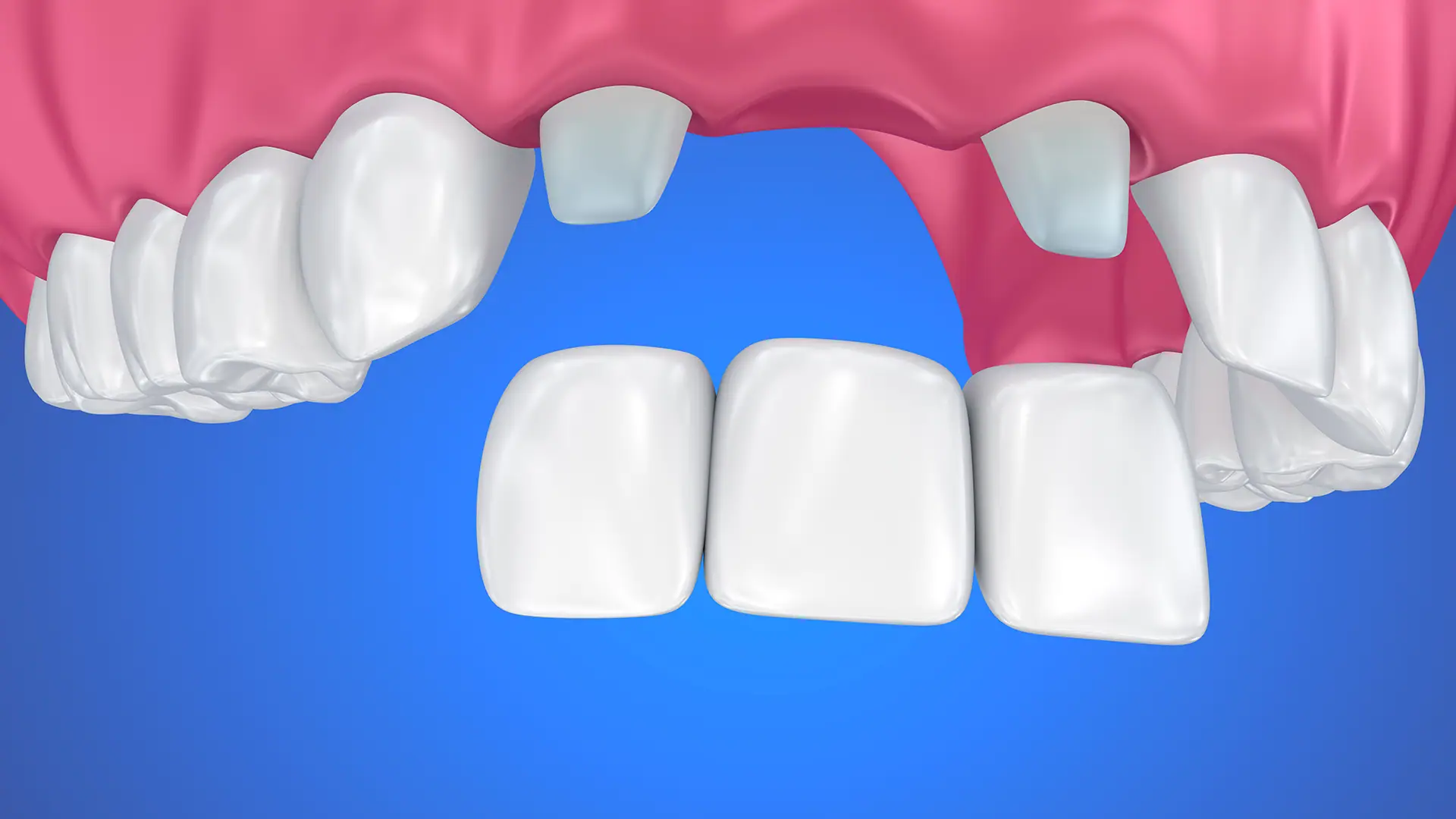 3D Illustration of Crown Dental Bridge