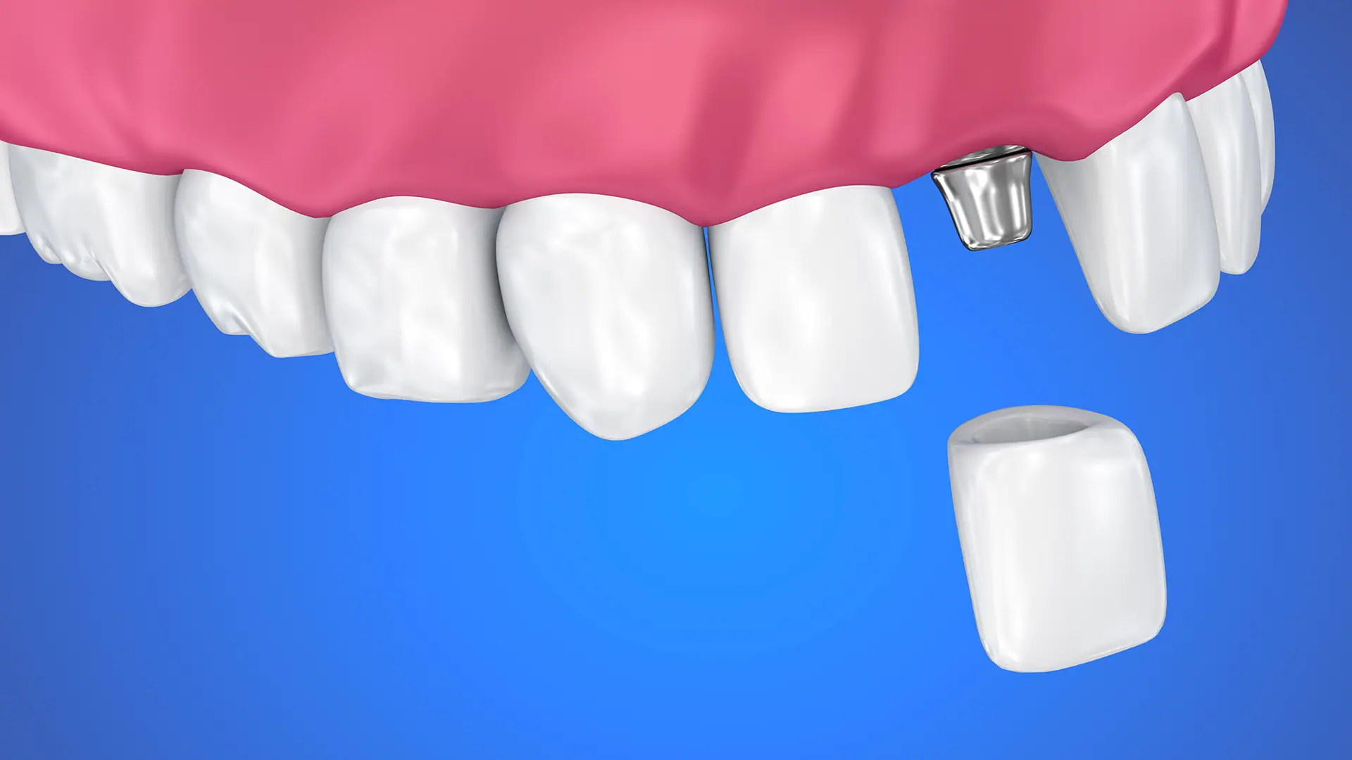 3D Illustration of Crown Used to Cover a Dental Implant