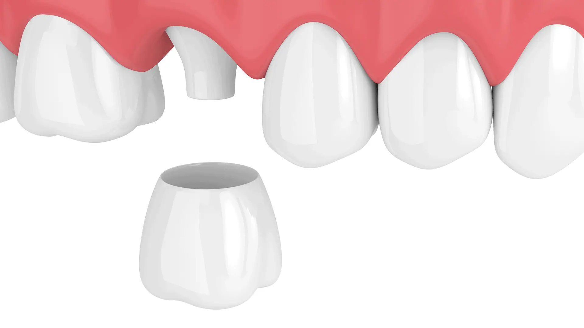 3D Illustration of Teeth Restored by Crown