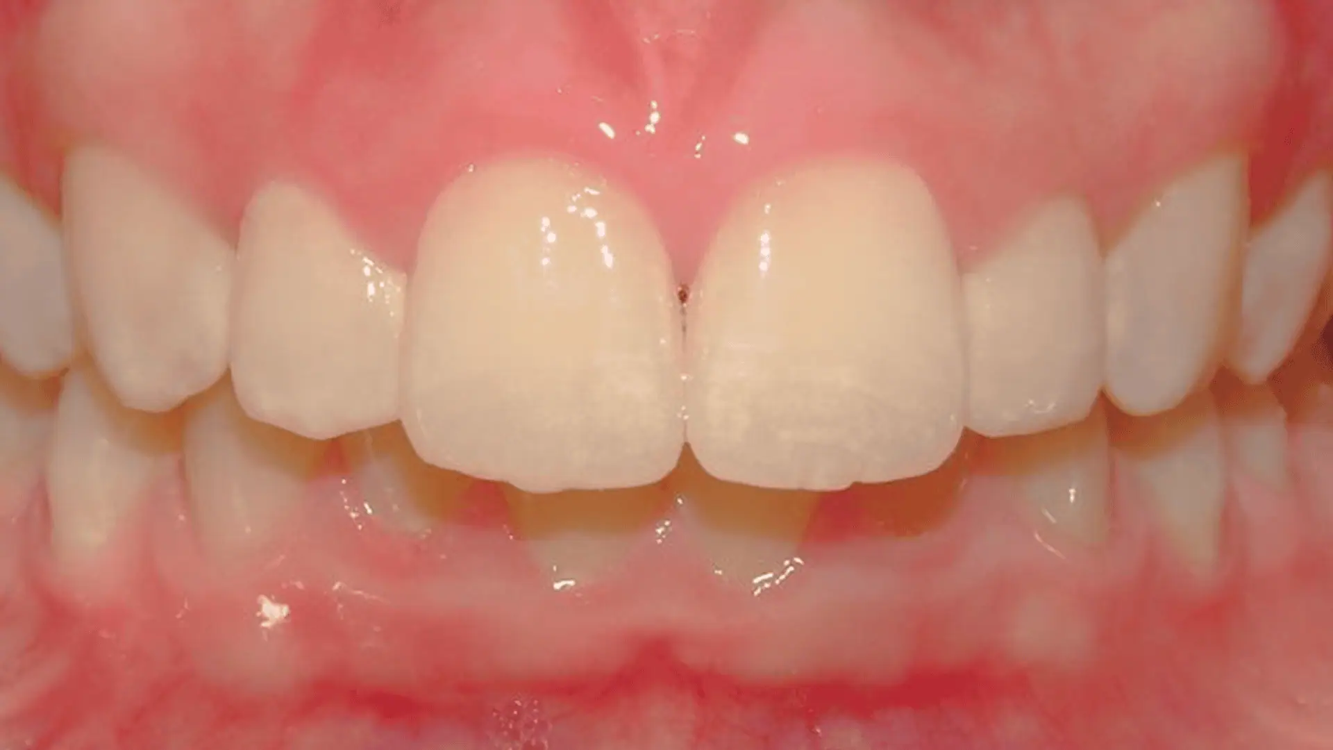 invisalign braces