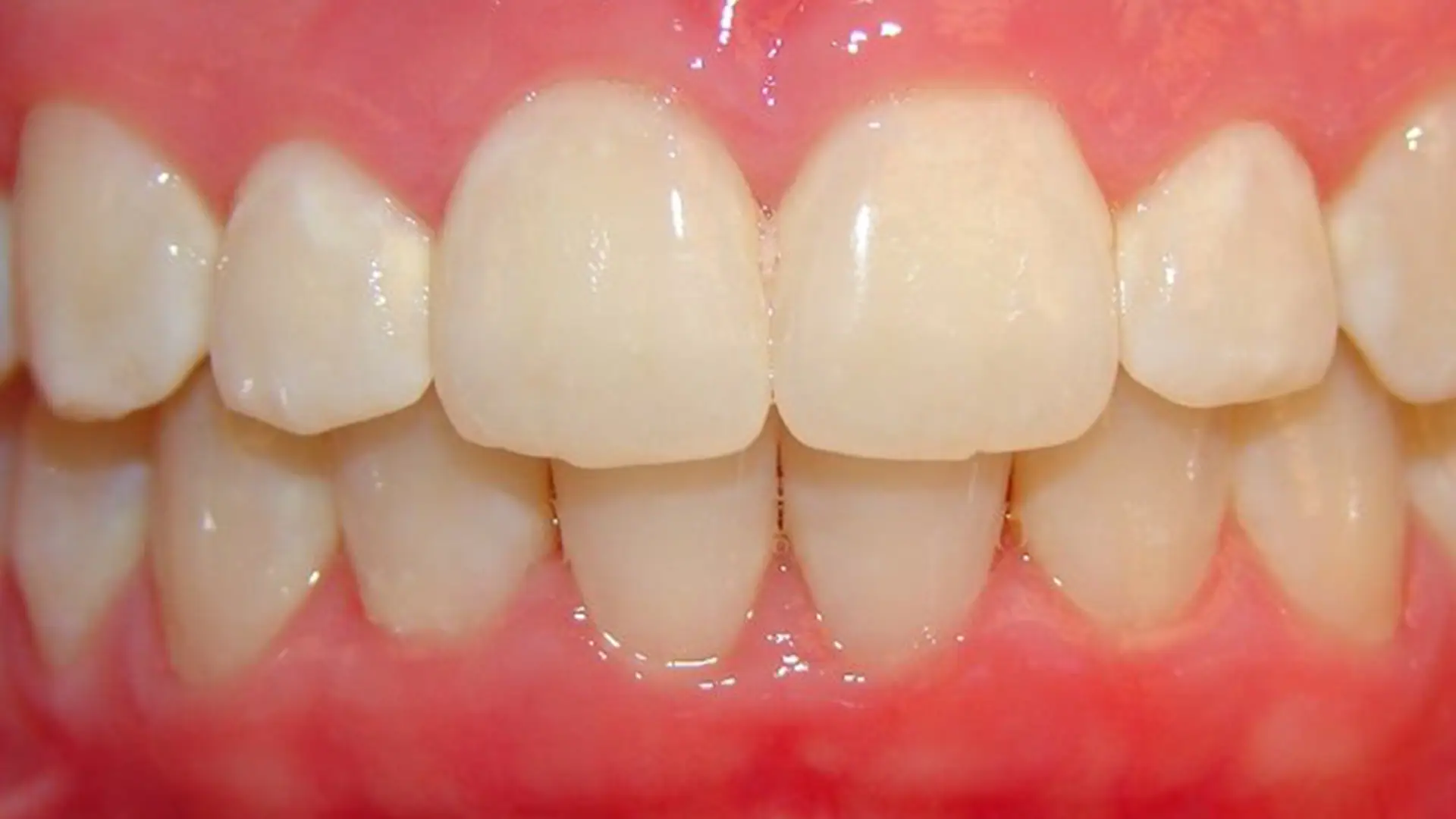 invisalign braces