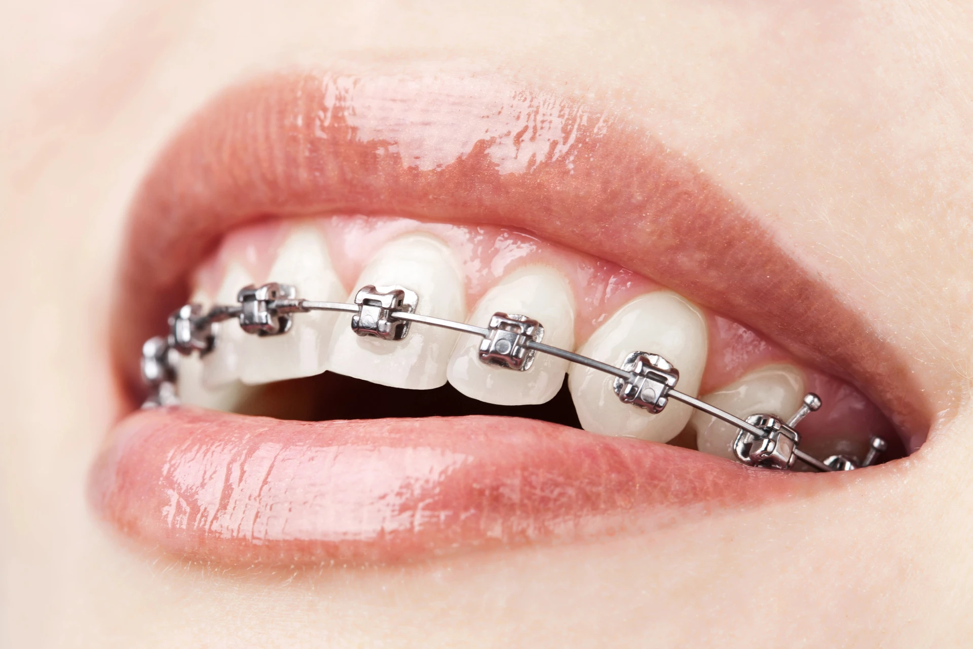 A Comprehensive Guide to Different Types of Braces