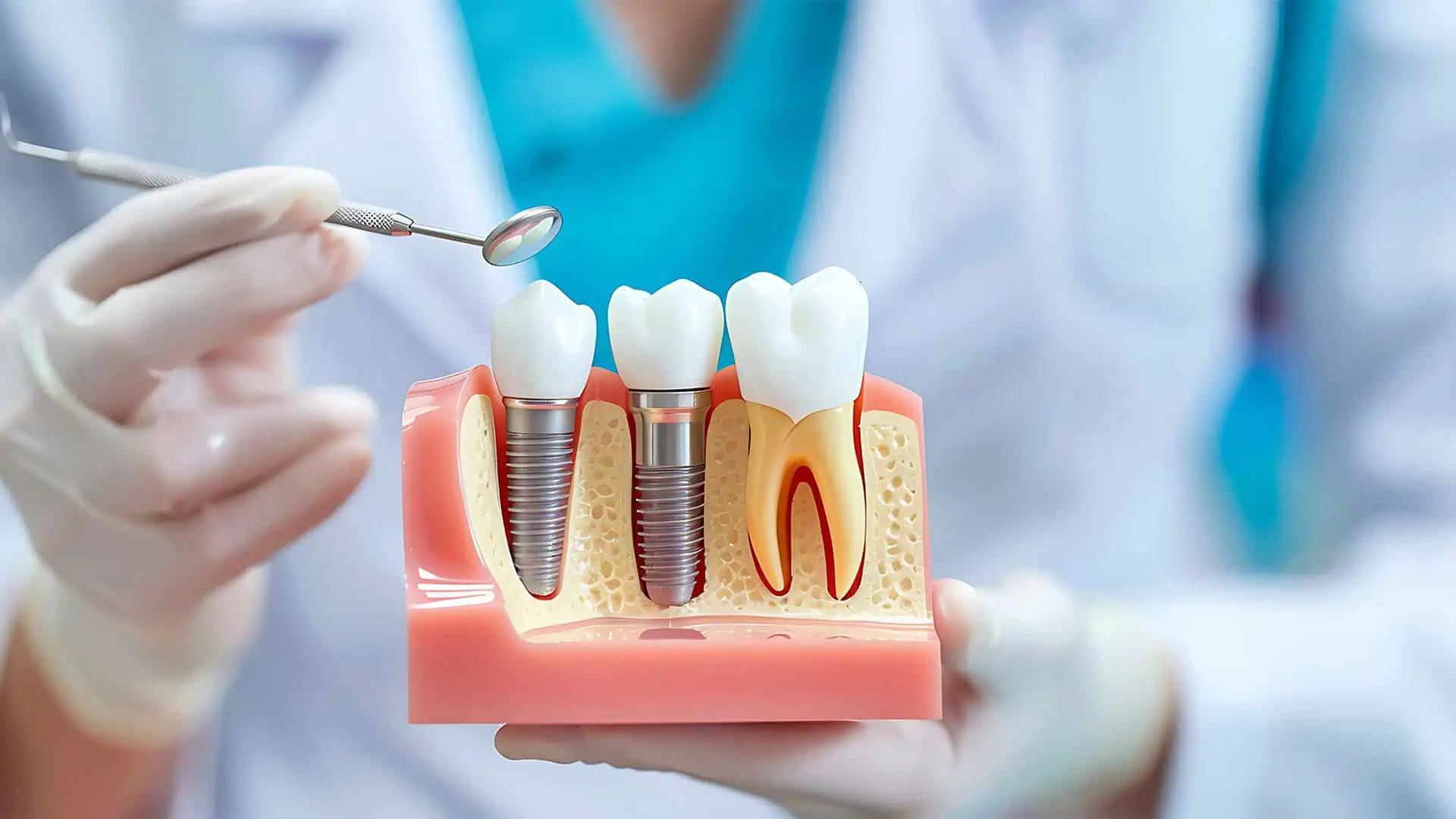 Understanding Dental Implants What They Are and How They Work