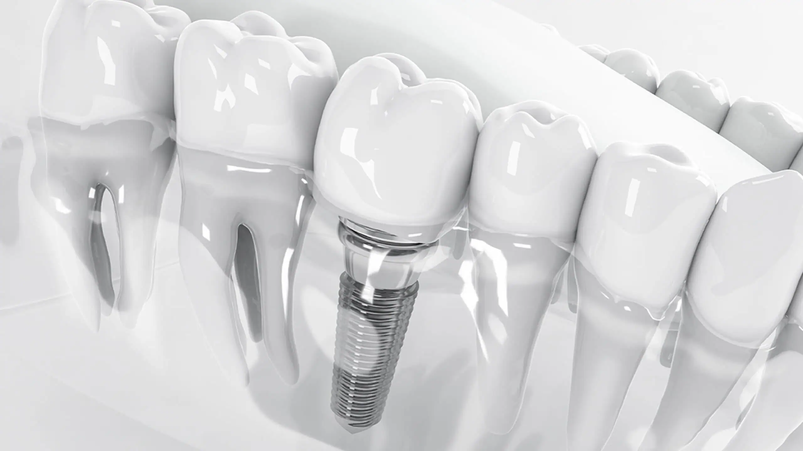 Step-by-Step Guide to the Dental Implant Procedures in Dubai