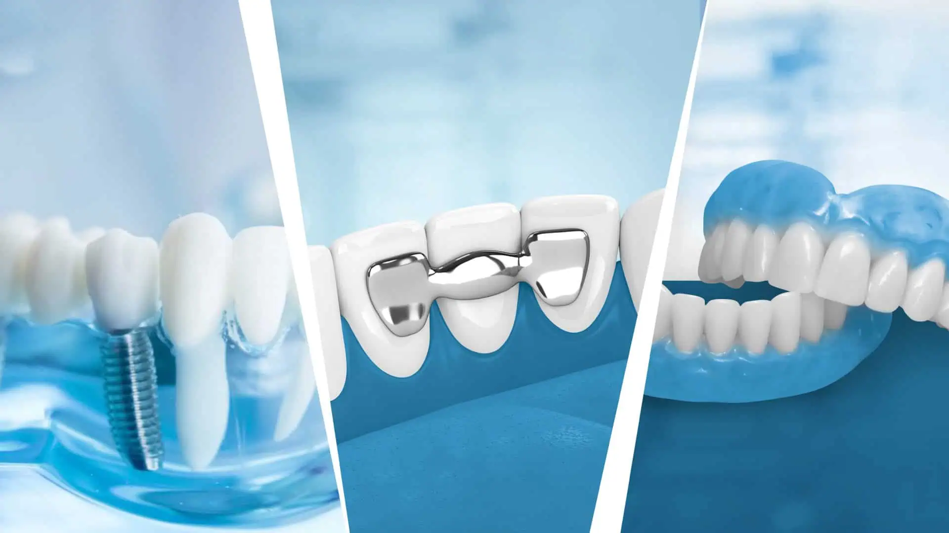 Dental Implants vs. Bridges vs. Dentures: Which Option is Best for You?