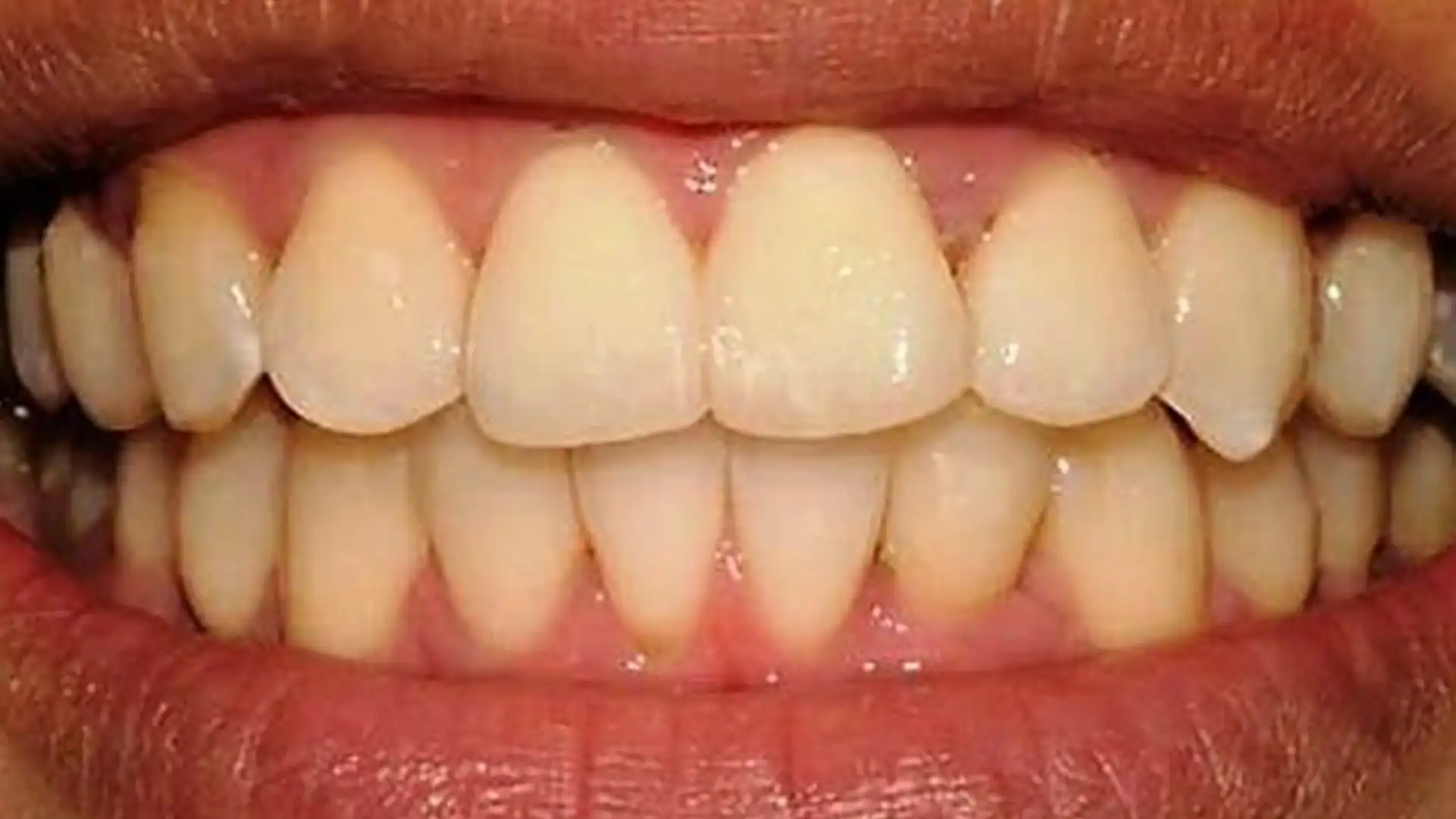 After Ceramic Braces - Case1