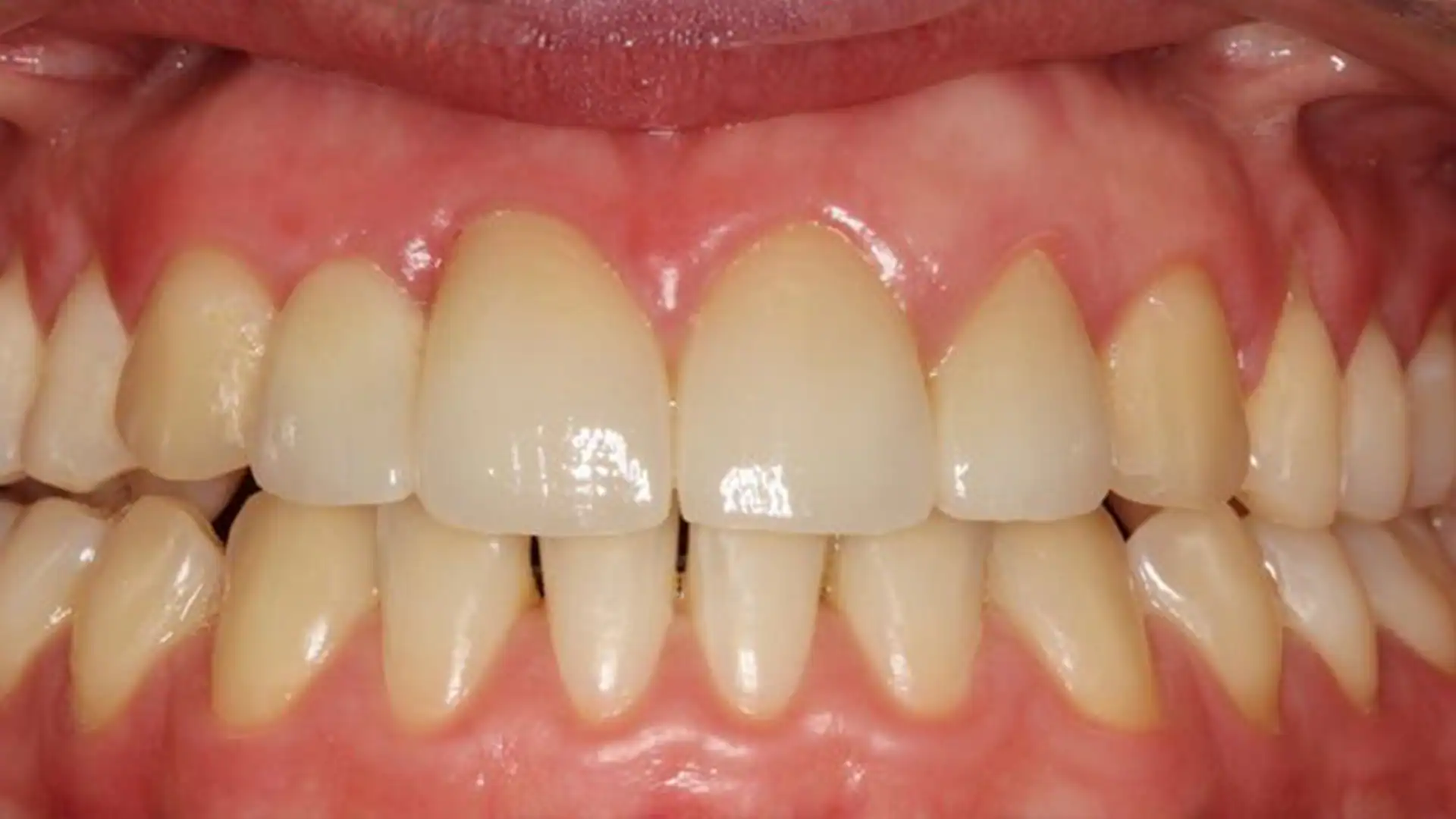 After Ceramic Braces - Case2