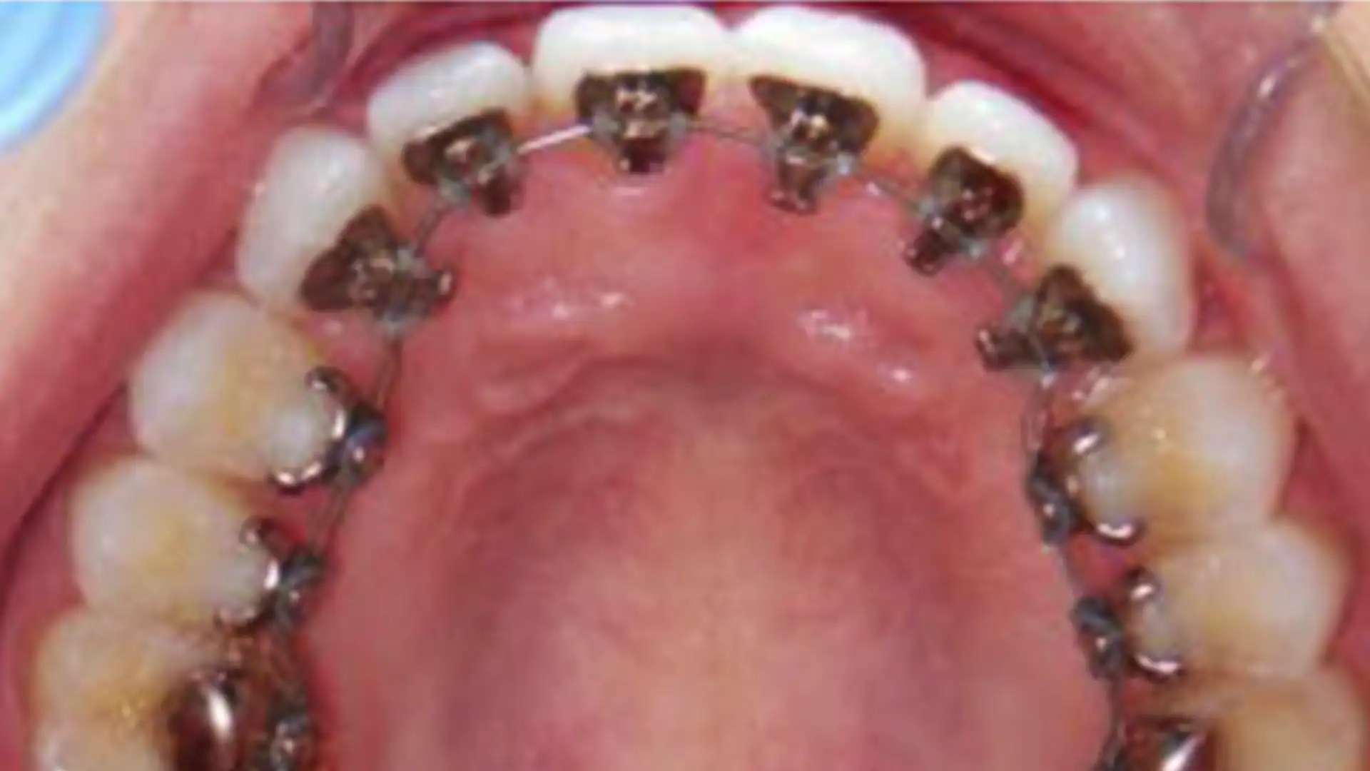 After Lingual Braces - Case1