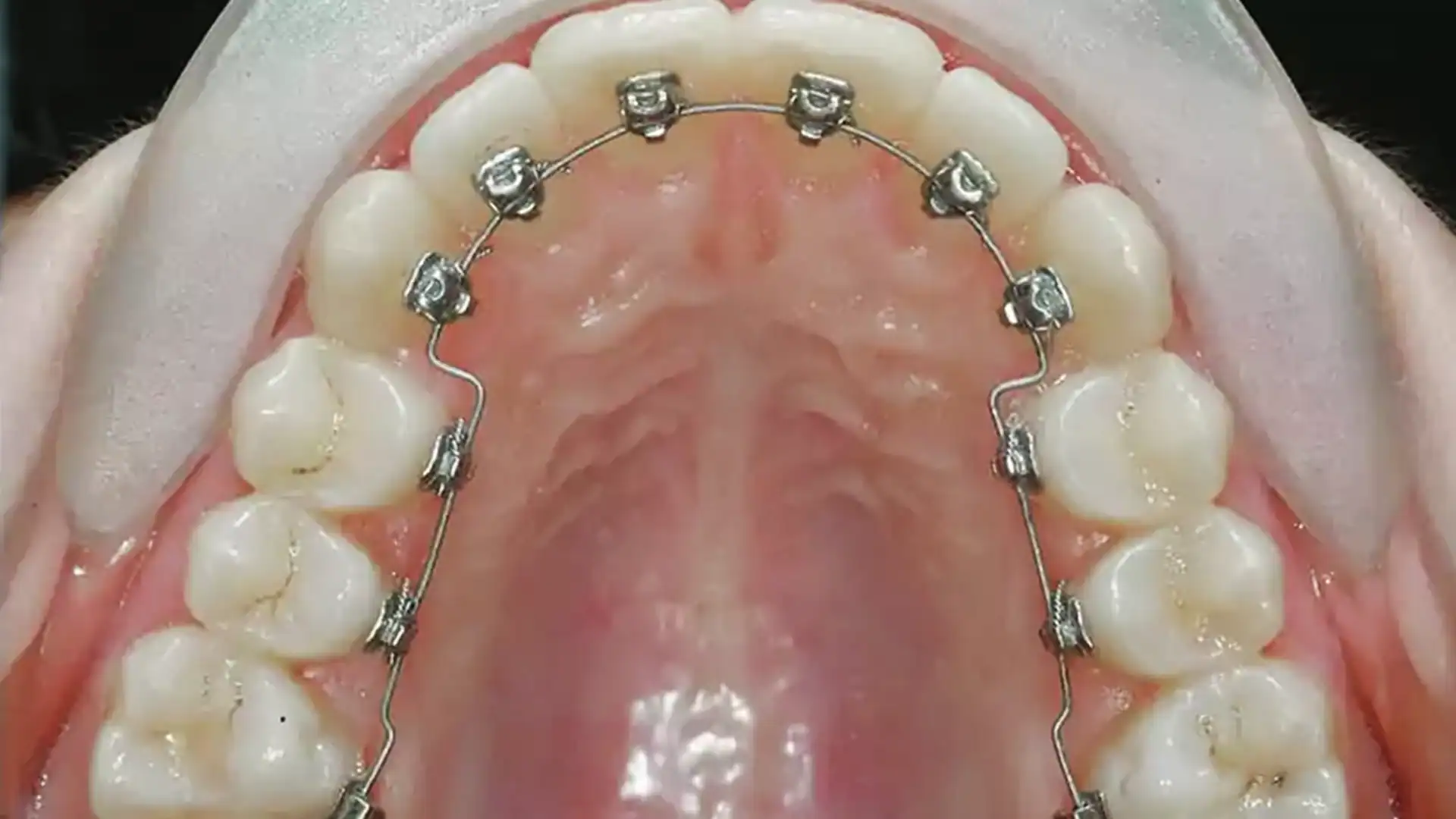After Lingual Braces - Case2