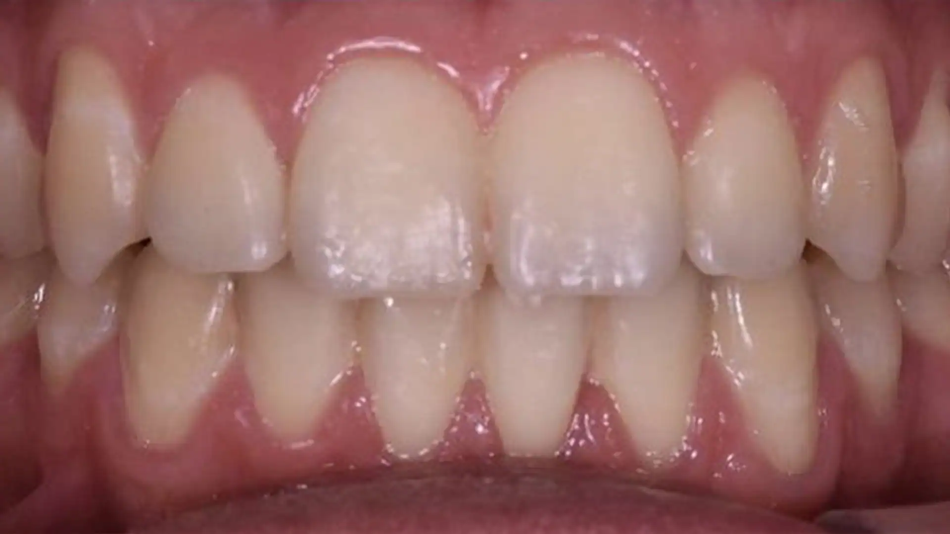After Metal Braces - Case2