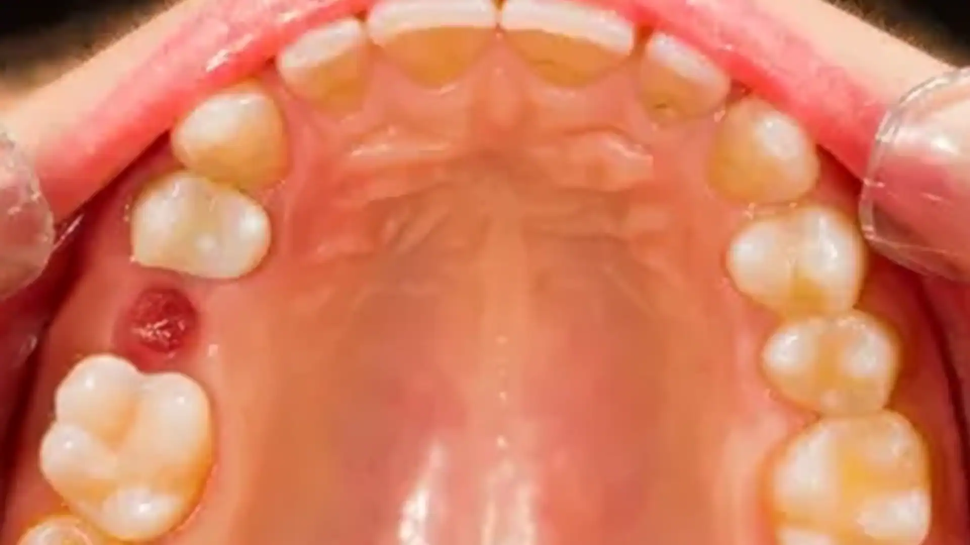 After Tooth Extraction - Case1