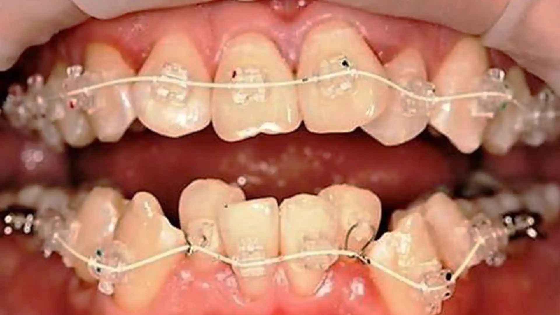Before Ceramic Braces - Case1