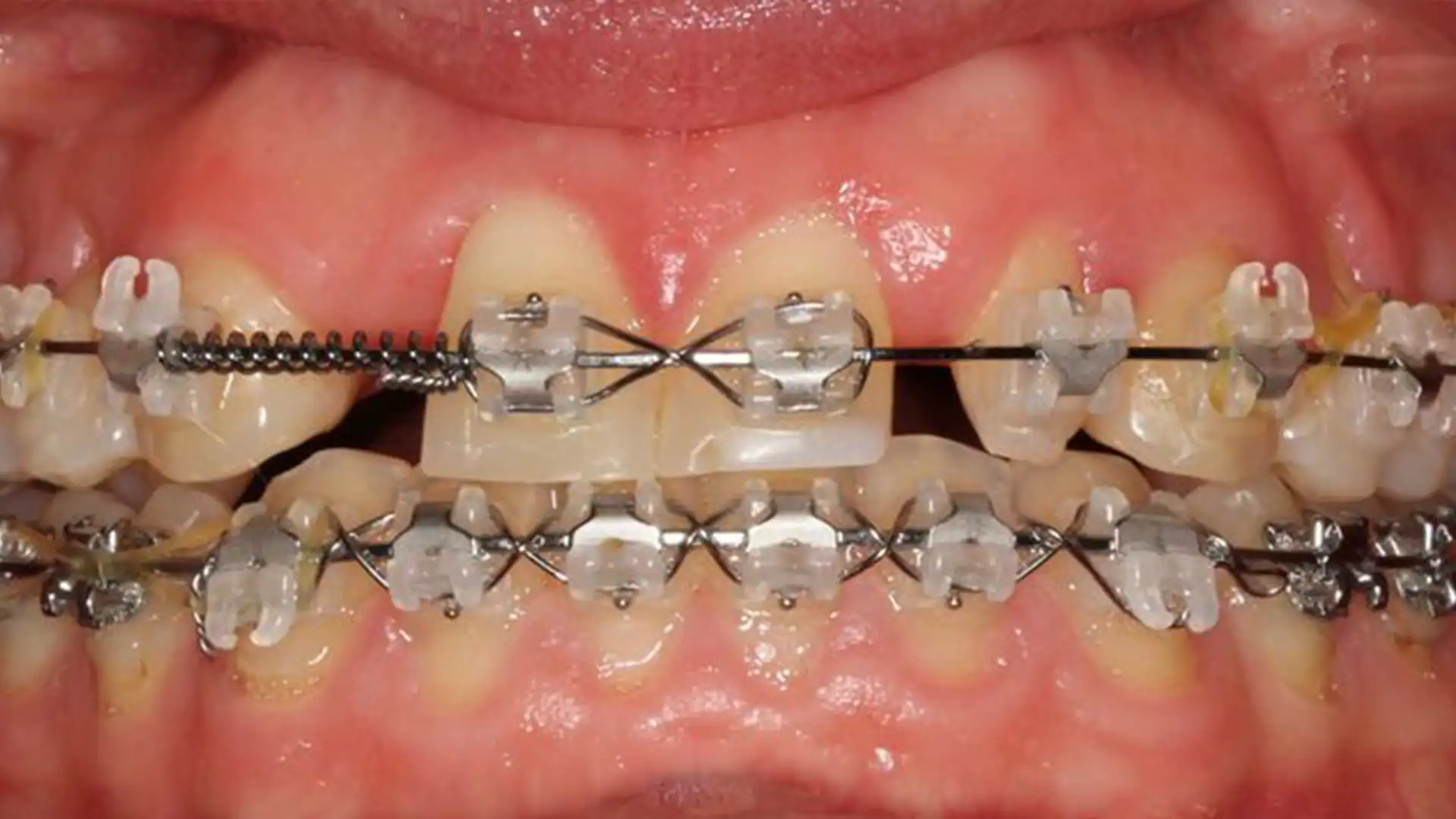 Before Ceramic Braces - Case2