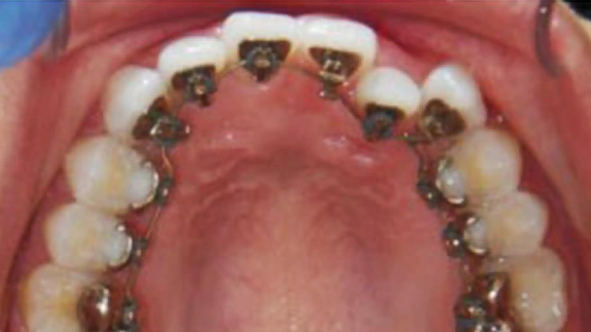 Before Lingual Braces - Case1