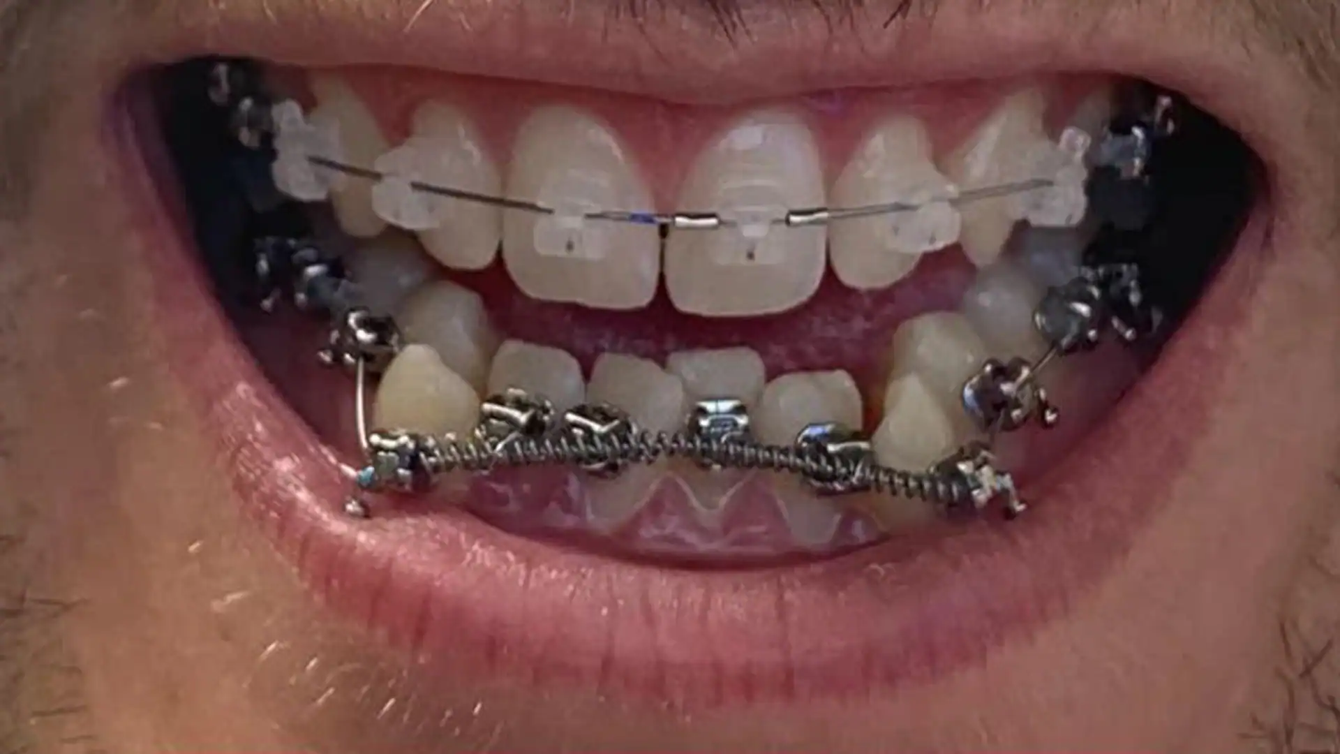 Before Metal Braces - Case1