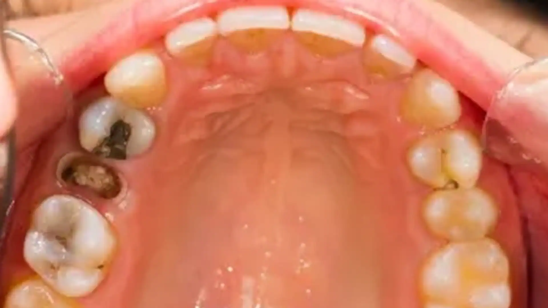 Before Tooth Extraction - Case1