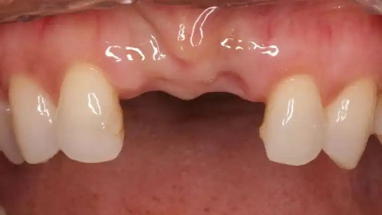 Before dental implants - Case 2