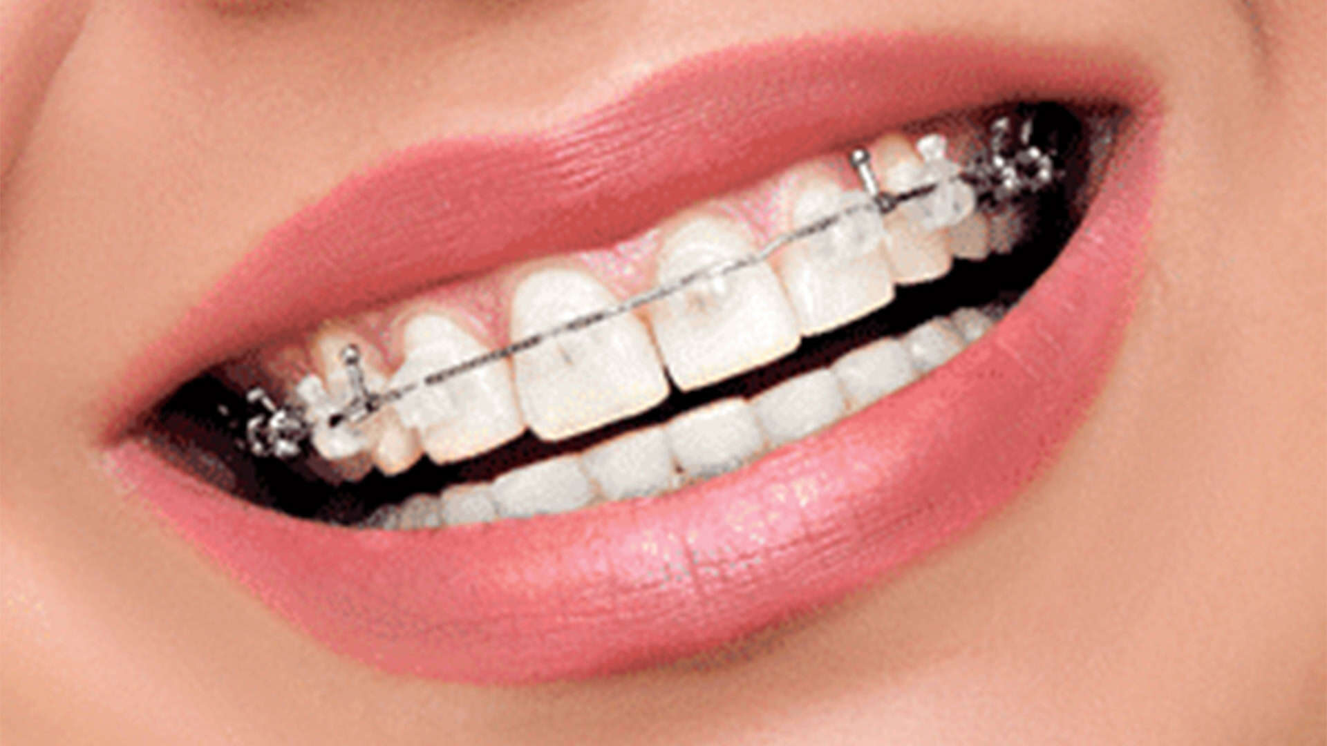 Ceramic-Braces