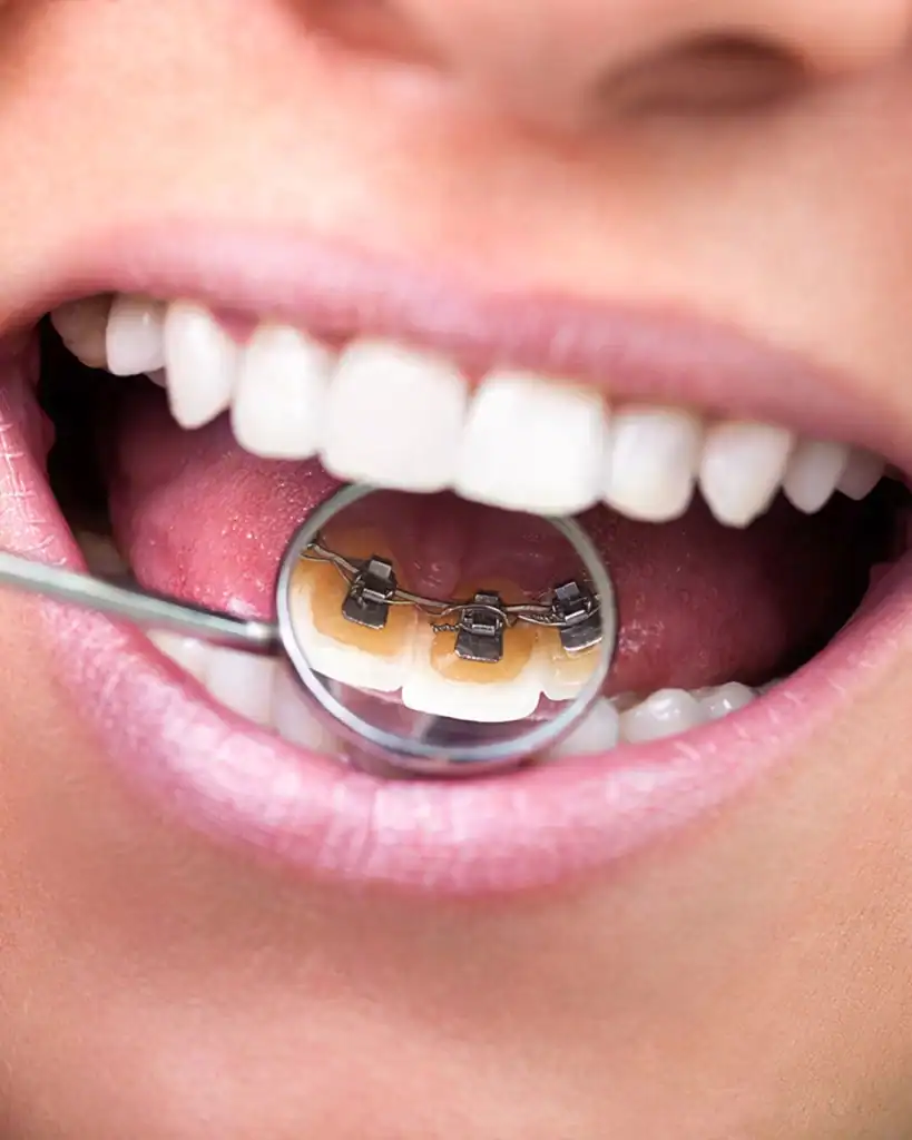 How Do Invisible Lingual Braces Work