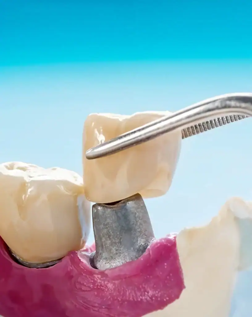 How Tooth Crowns Can Transform Your Life
