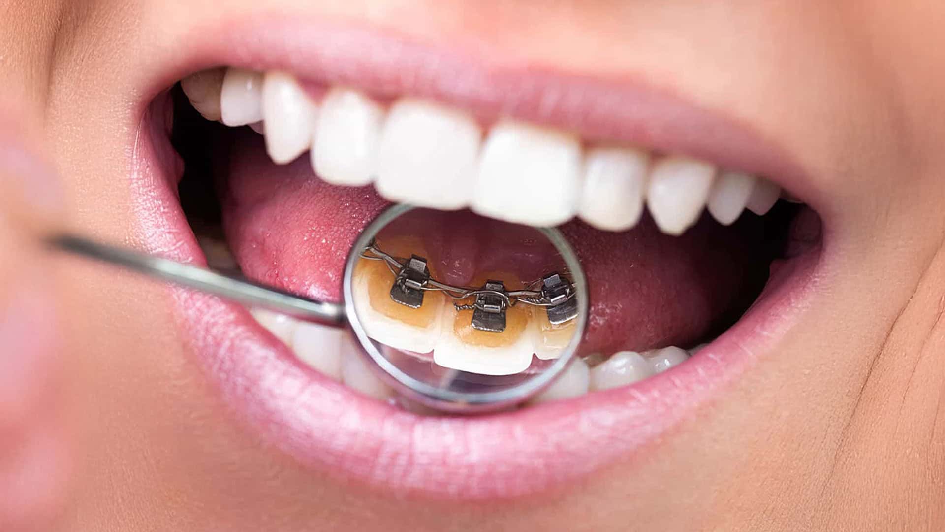 Lingual-Braces