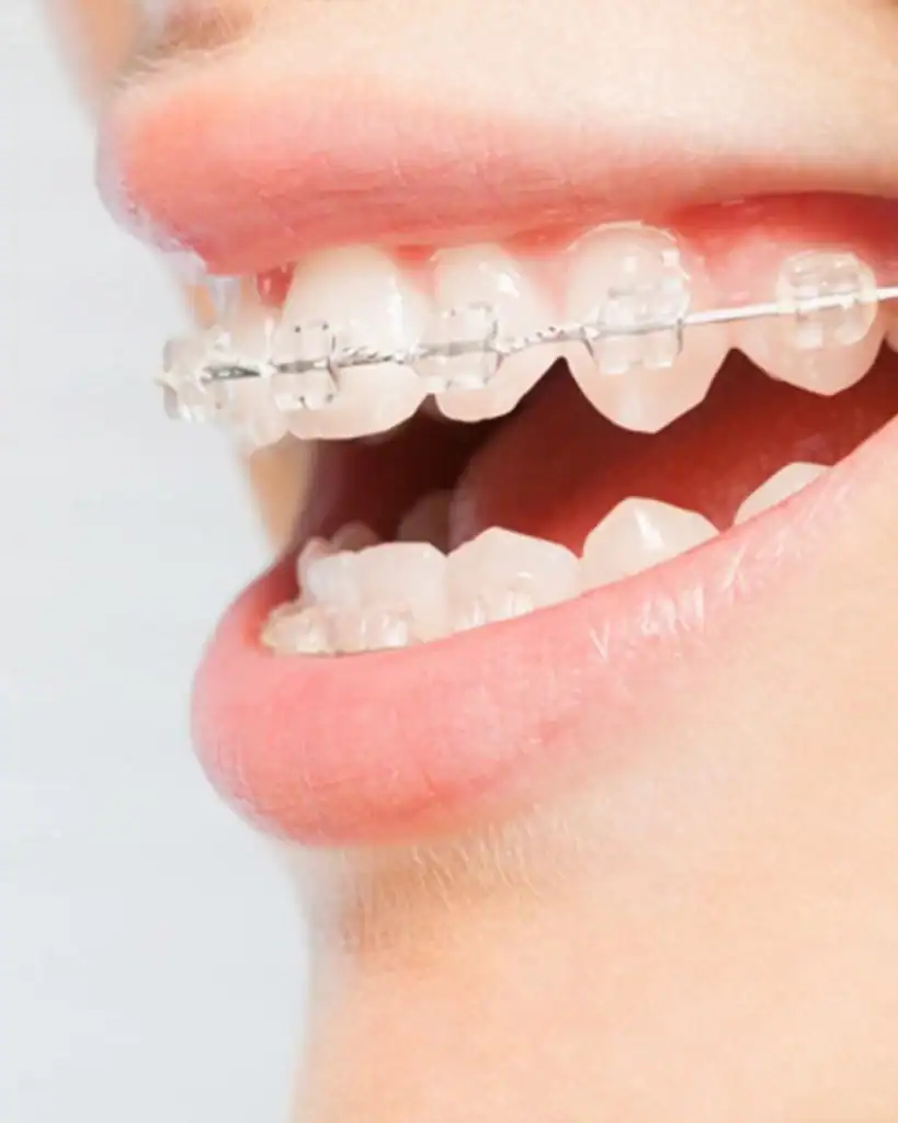 What Are Ceramic Braces