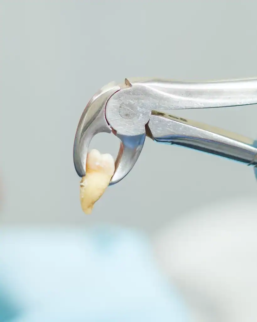 What Is Tooth Extraction in Dubai