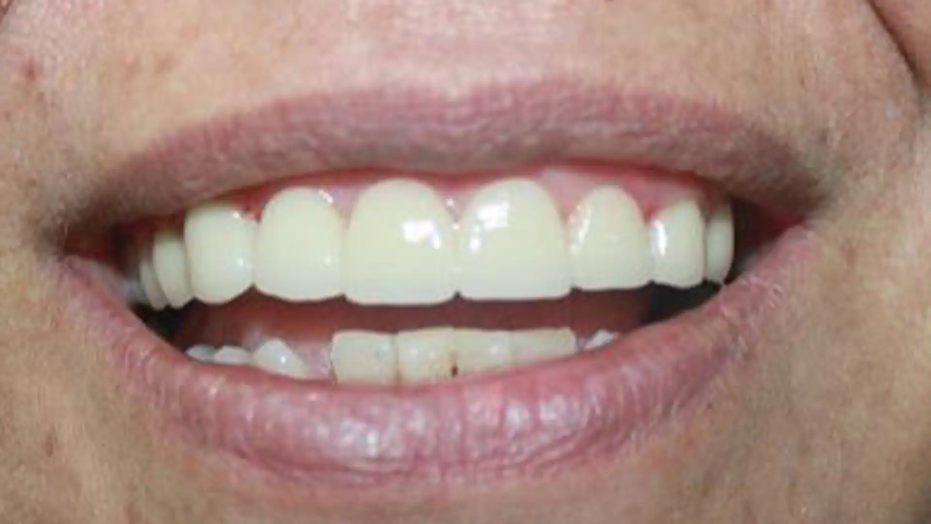 after dental bridges - Case 2