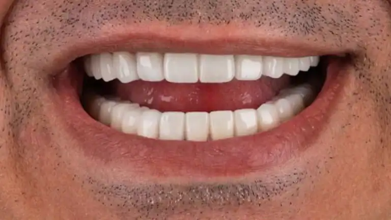 after dental implants - Case 1