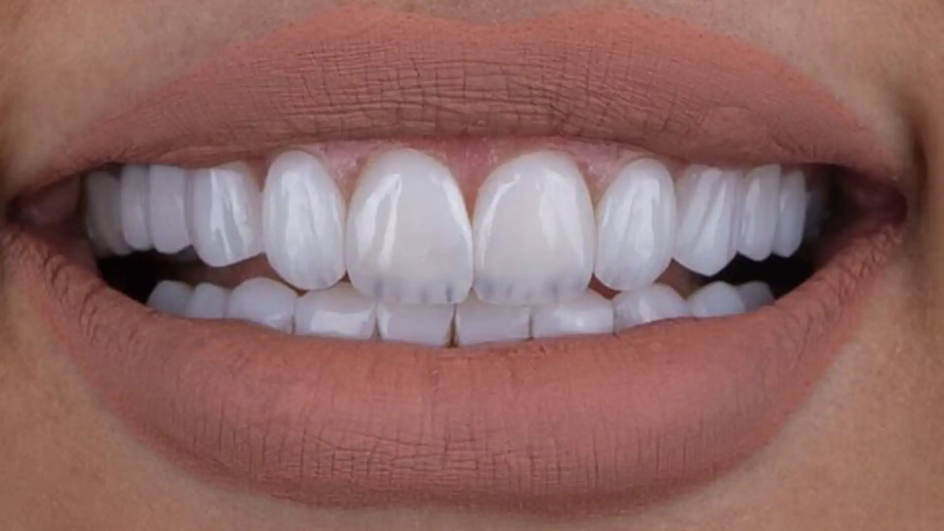 after hollywood smile - Case 1