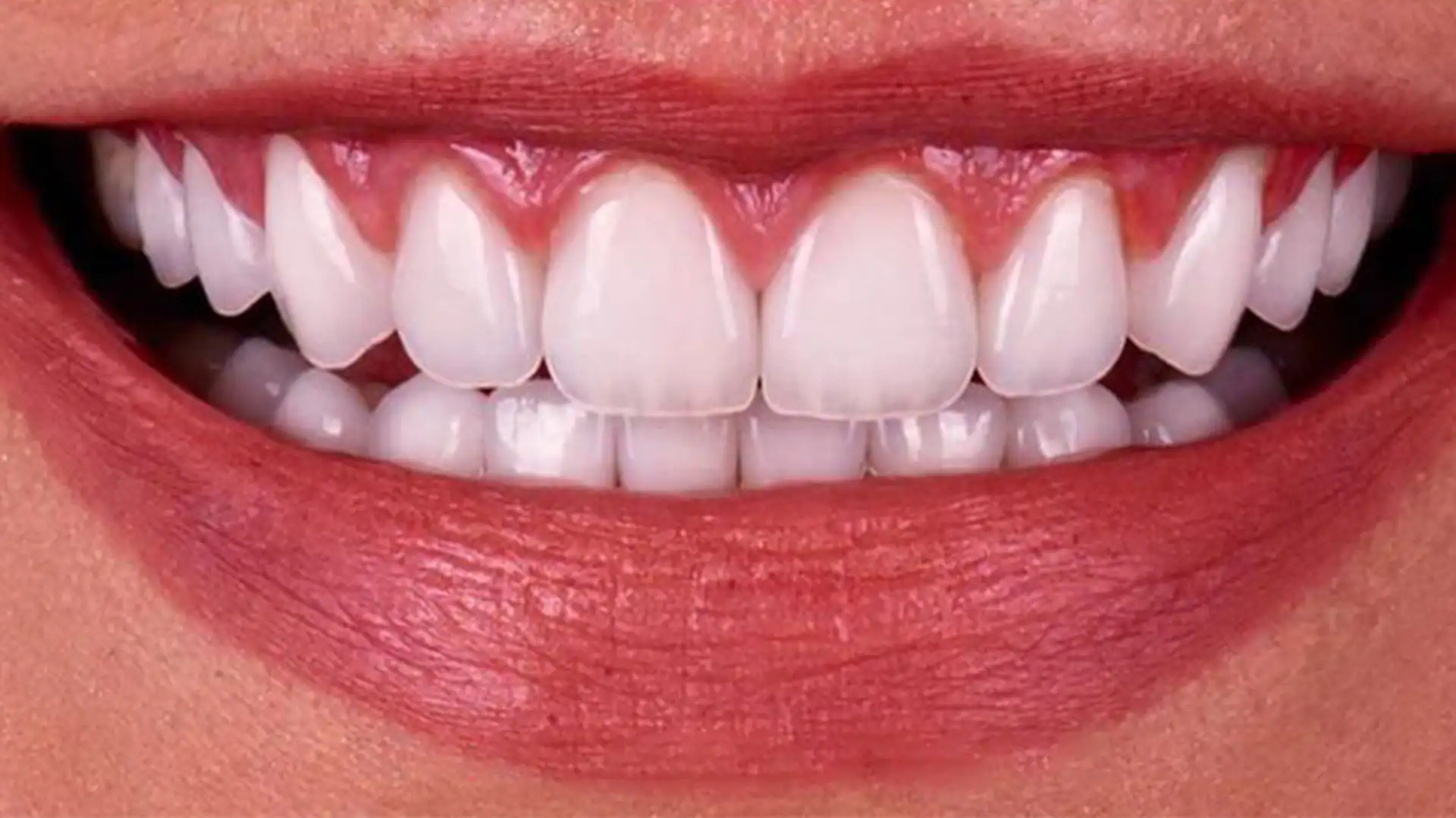 after hollywood smile - Case 2