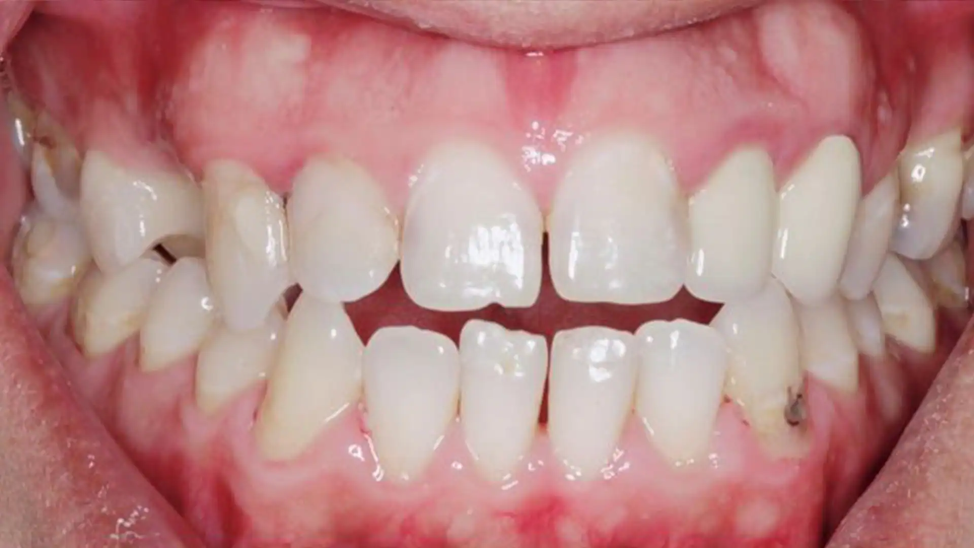 after teeth cleaning - Case 2