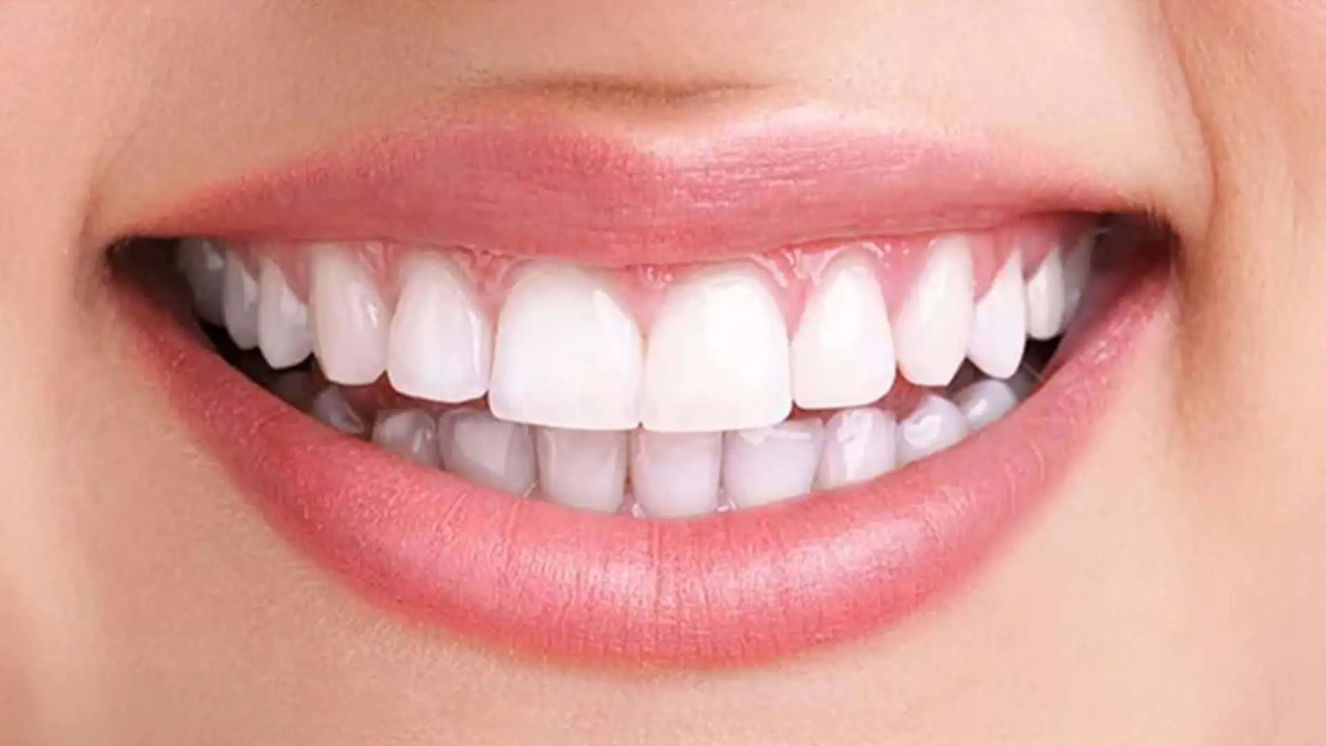 after-teeth-whitining-Case-2