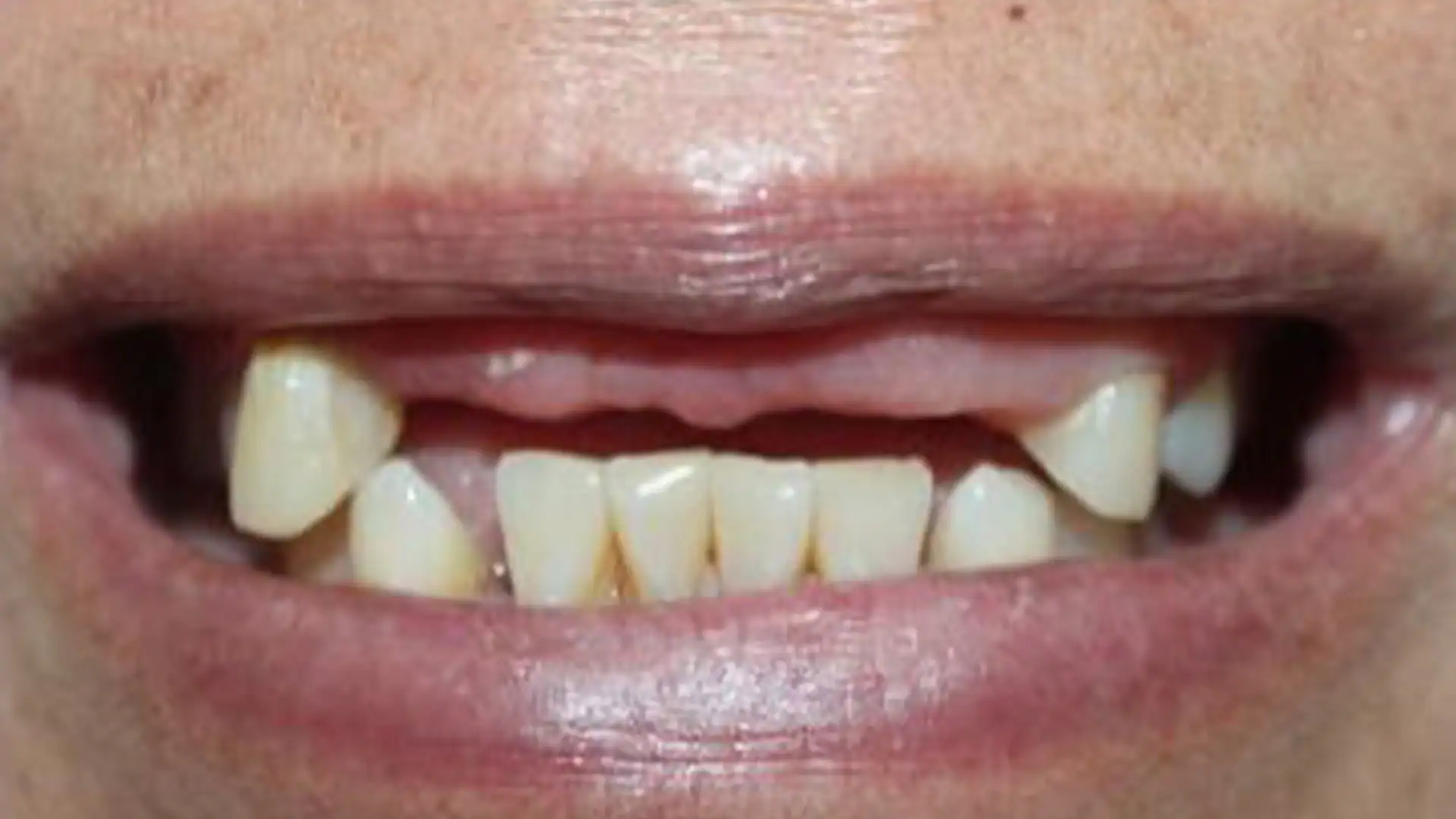 before dental bridges - Case 2
