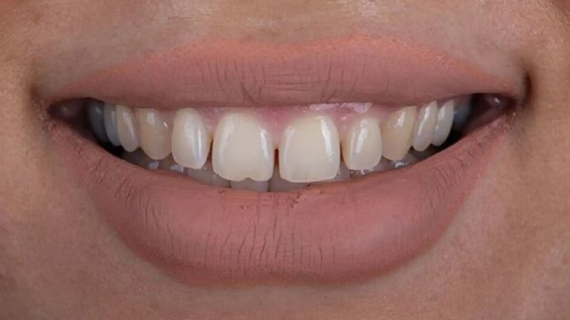 before hollywood smile - Case 1