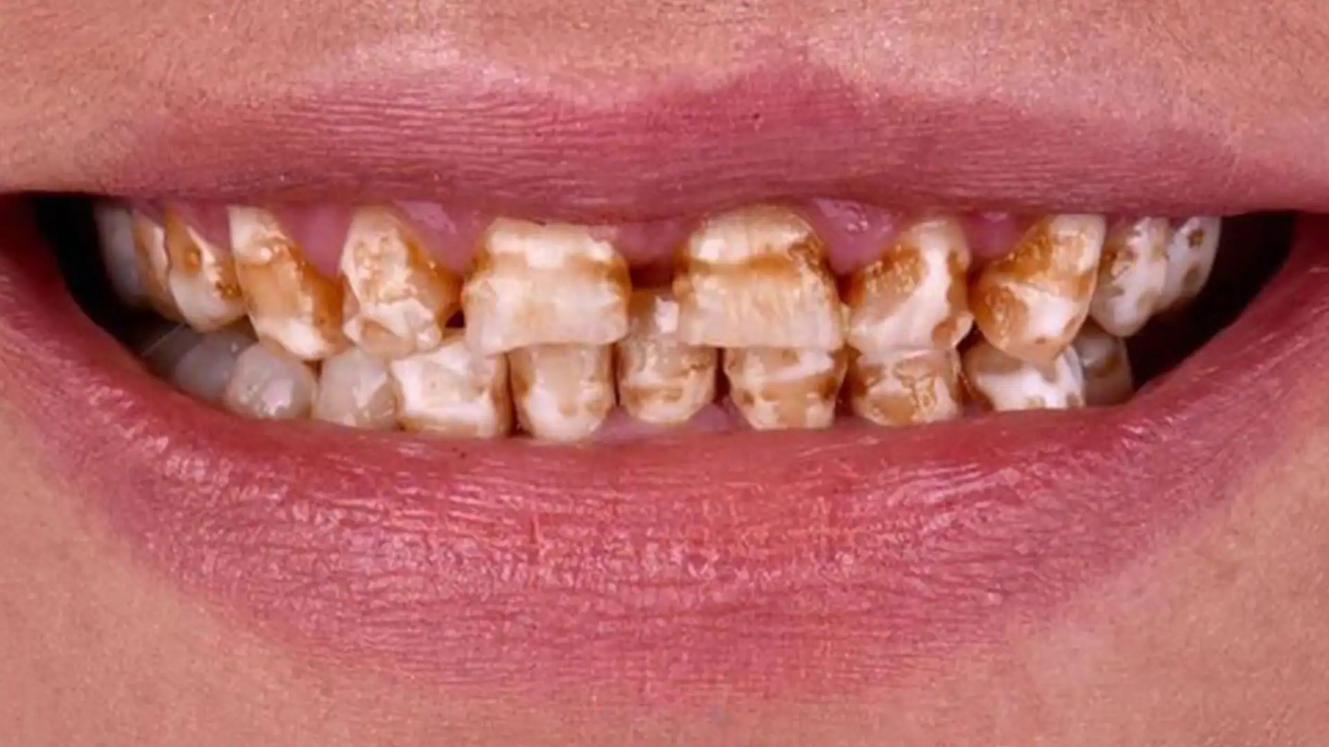 before hollywood smile - Case 2