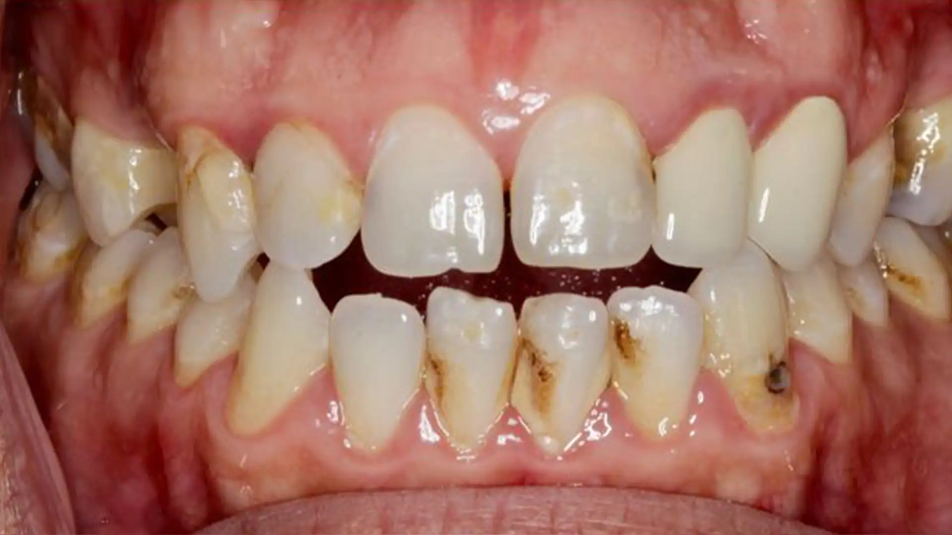 before teeth cleaning - Case 2