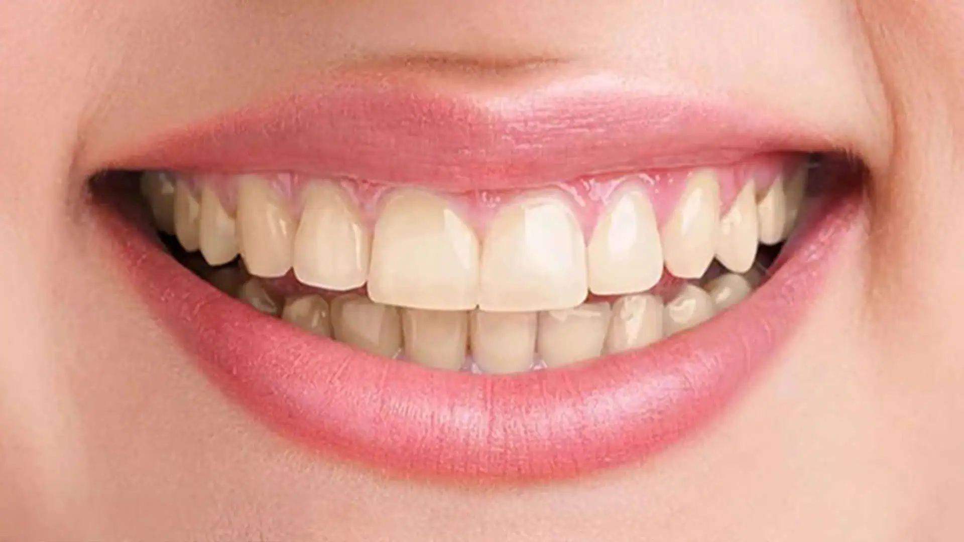 before-teeth-whitining-Case-2